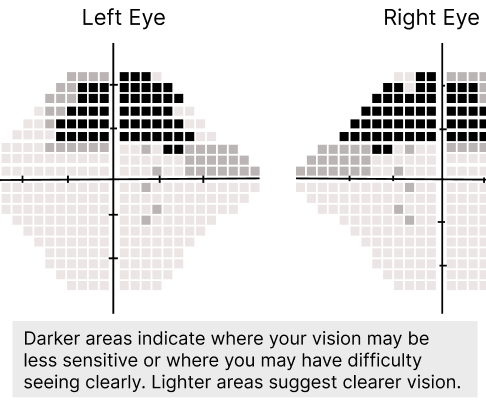 Iteration 2: paired Left Eye and Right Eye visual field plots with square sensitivity cells, crosshair axes, darker upper regions, lighter lower and peripheral regions, and the explanatory text about darker and lighter areas.