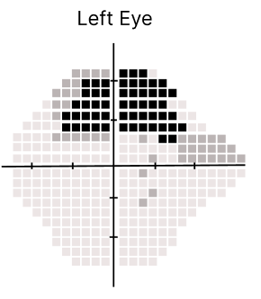 Iteration 1: Left Eye visual field plot with square sensitivity cells, crosshair axes, darker cells concentrated above the horizontal axis, and lighter cells extending below and toward the periphery.